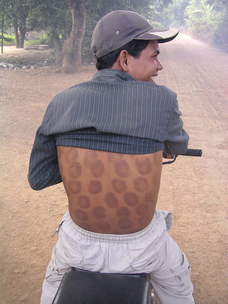 Sambath shows off the after effects of his cupping